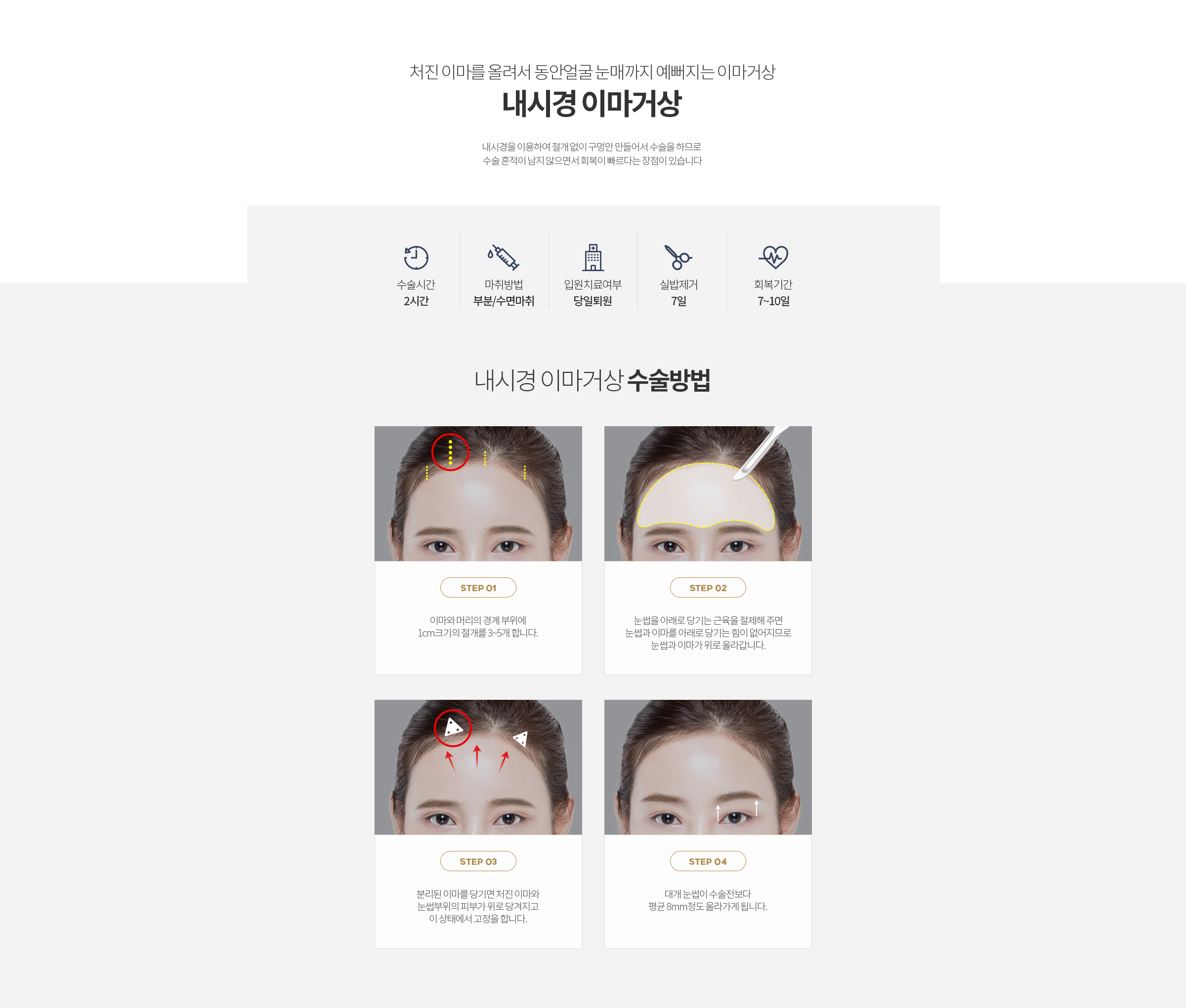 내시경이마거상, 이마리프팅, 이마시술